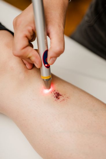 Softlaseranwendung bei Schürfwunden